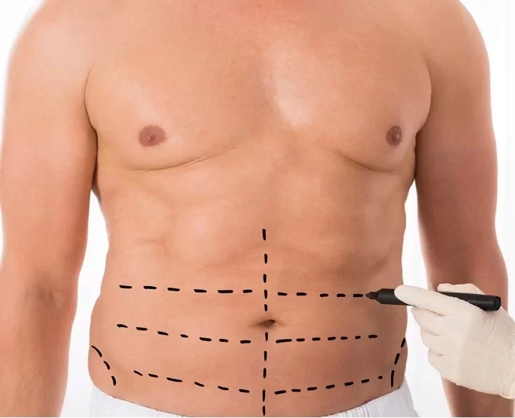 koilioplastiki-gia-andres.1