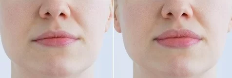 lip-lift-before-after